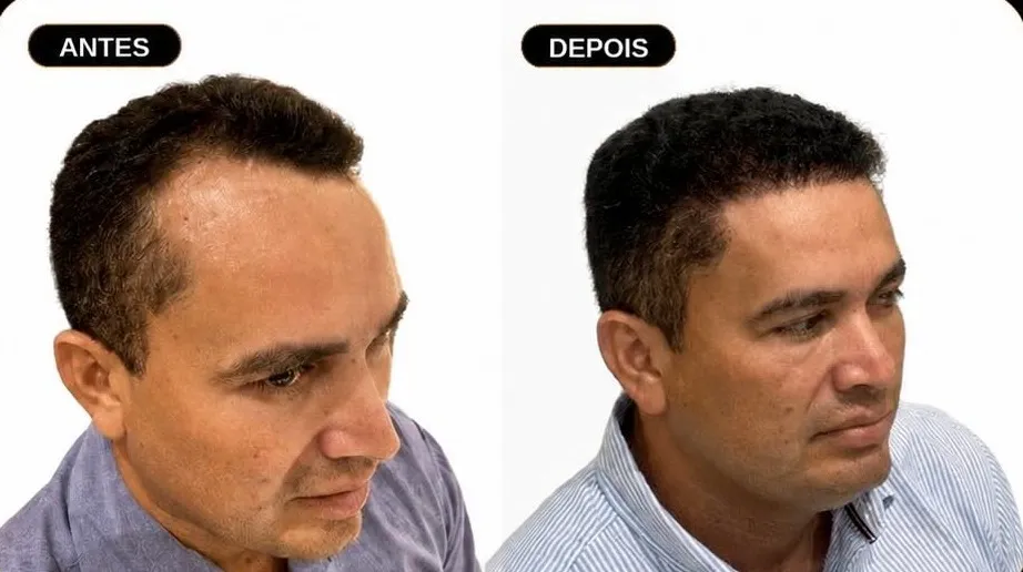 Antes e depois de transplante capilar de paciente do DHT Instituto, 6 meses após o procedimento